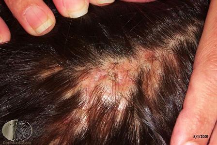 درمان ریزش مو در بیماری لیکن پلان